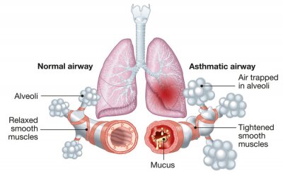 Canvas Asthma, normal and asthmatic airways, medically illustration